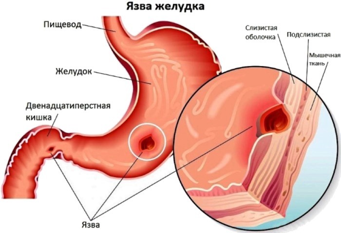 Язва желудка
