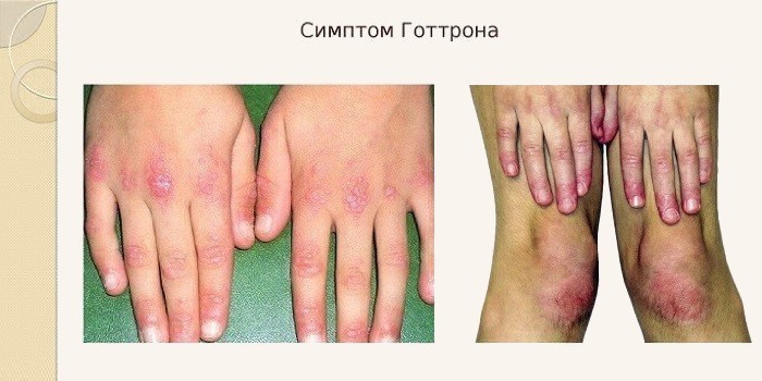 Симптом Готтрона