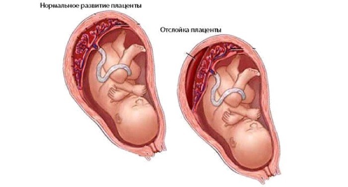 Отслойка плаценты