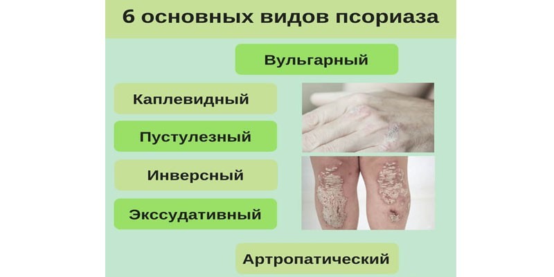 Виды псориаза