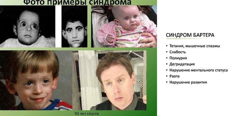 Синдром Барттера и примеры фото