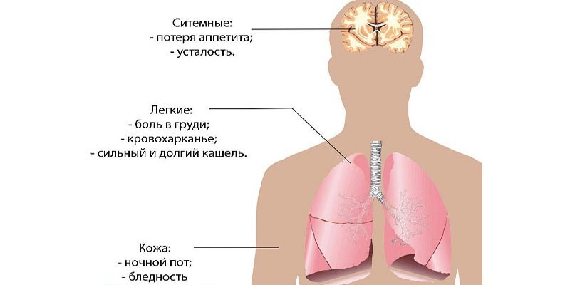 Симптомы открытой формы туберкулеза