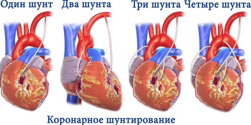 Коронарное шунтирование