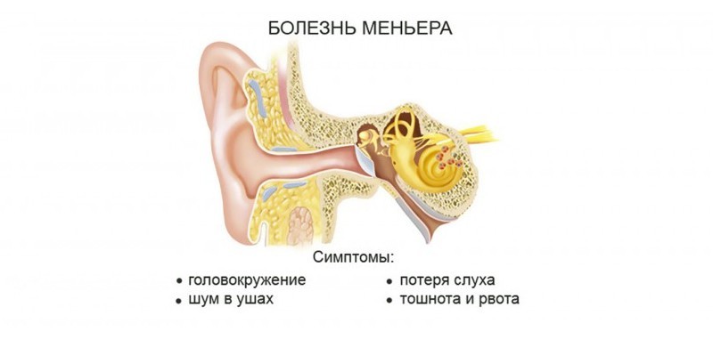 Симптомы болезни Меньера
