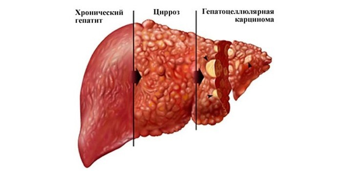 Стадии заболевания печени