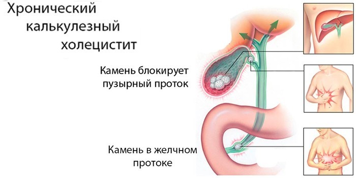 Хроническая калькулезная форма