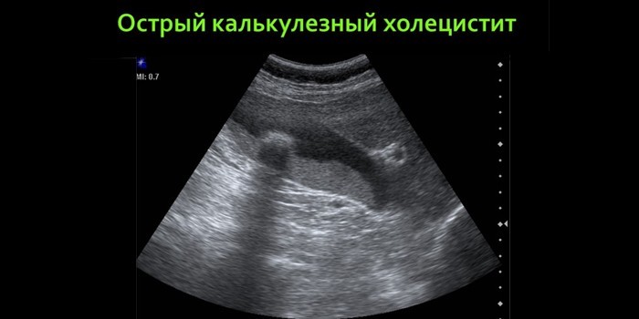 Калькулезная форма на УЗИ