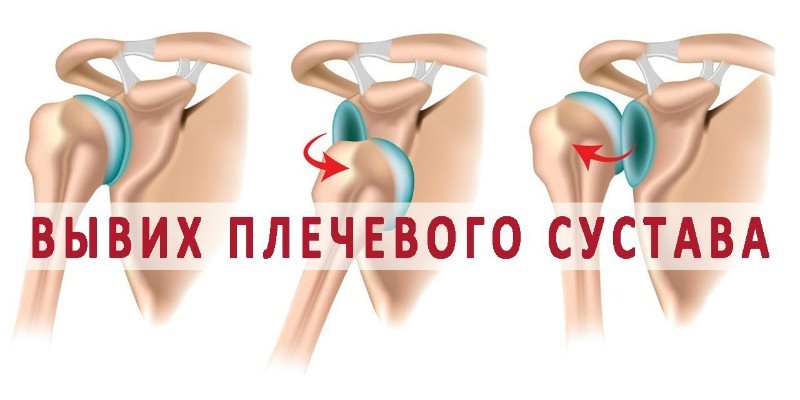Вывиж плечевого сустава на схеме