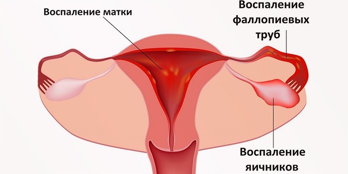 Воспаления маточных труб, яичников