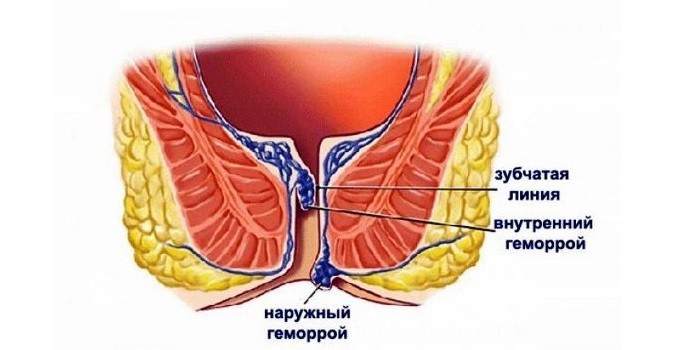 Внутренний и наружный геморрой