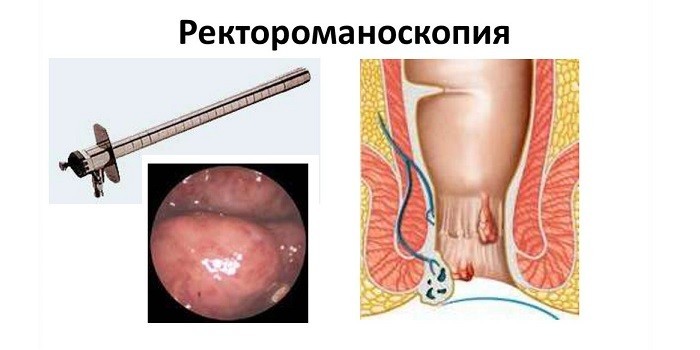 Схема проведения ректороманоскопии