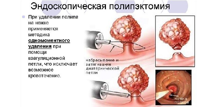 Эндоскопическая полипэктомия