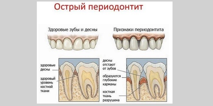 Острый периодонтит