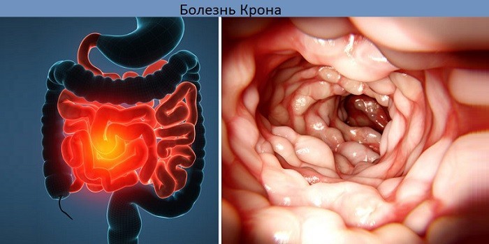 Болезнь Крона