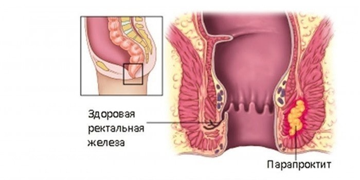 Парапроктит на схеме