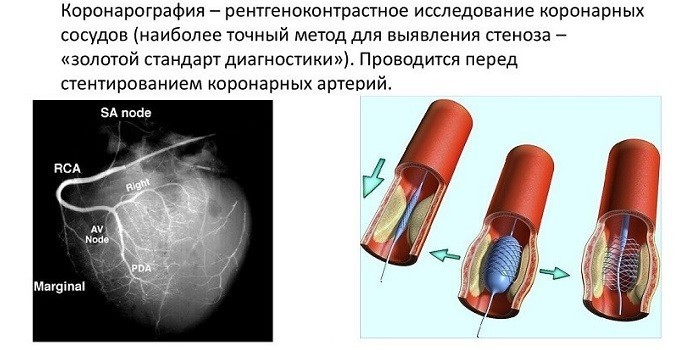 Коронография