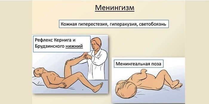 Менингеальный синдром