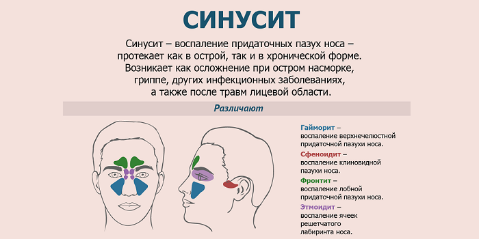 Определение синусита