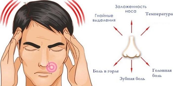 Признаки синусита