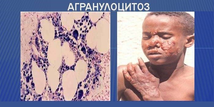 Агранулоцитоз