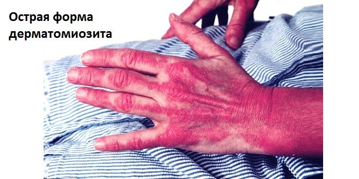 Симптомы дерматомиозита в острой форме