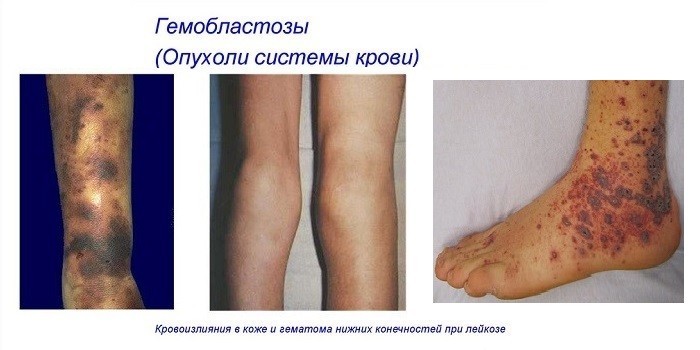 Так выглядят гемобластозы
