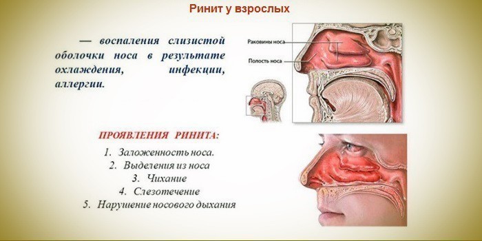 Симптомы ринита у взрослых