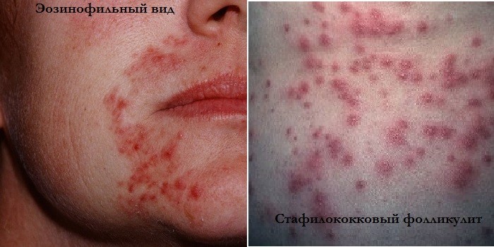 Эозинофильный и стафилококковый вид заболевания