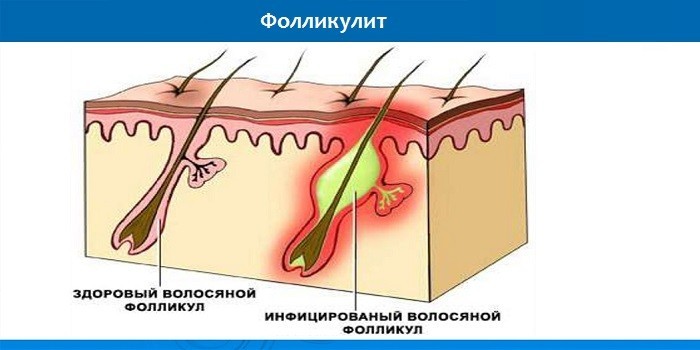 Инфицированный волосяной фолликул