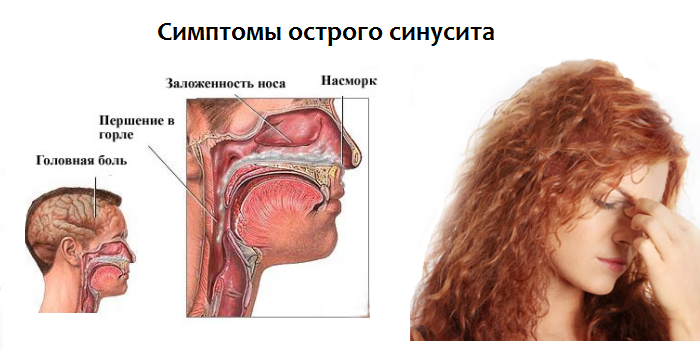 Симптомы острого синусита