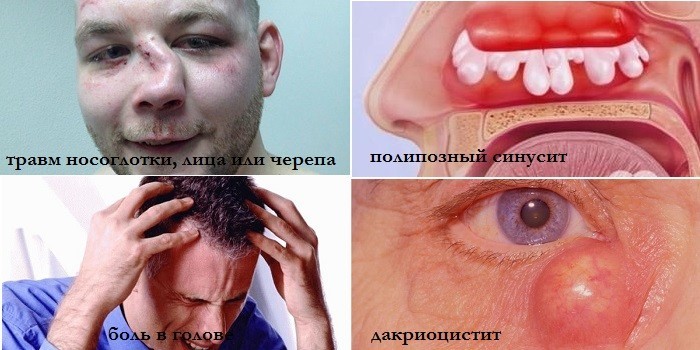 Травмы носоглотки, полипозный синусит, дакриоцистит и головные боли
