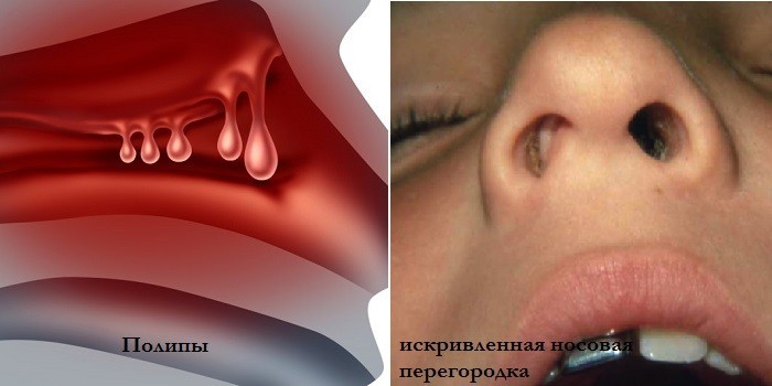 Полипы и искривленная носовая перегородка