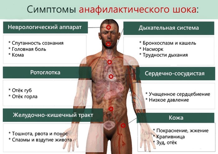 Симптомы анафилактического шока