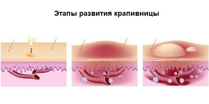 Этапы развития крапивницы