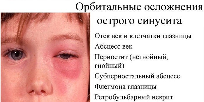 Орбитальные осложнения острого синусита