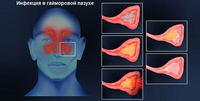Признаки  инфекции в гайморовых пазухах