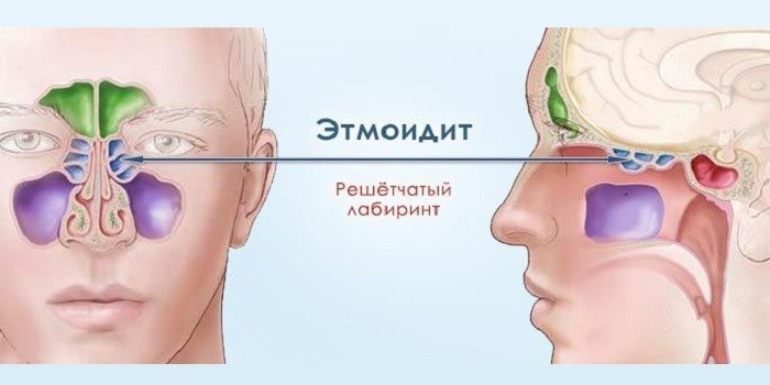 Воспаление решетчатого лабиринта
