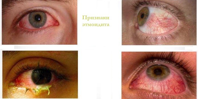 Признаки этмоидита