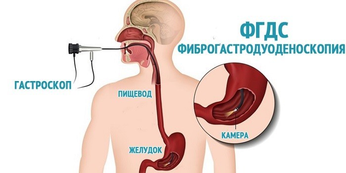 Проведение фиброгастродуоденоскопия