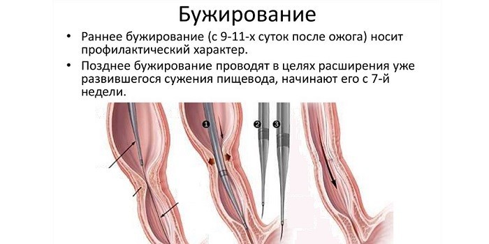Проведение бужирования