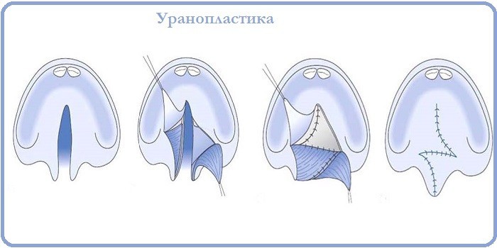 Пластика твердого неба