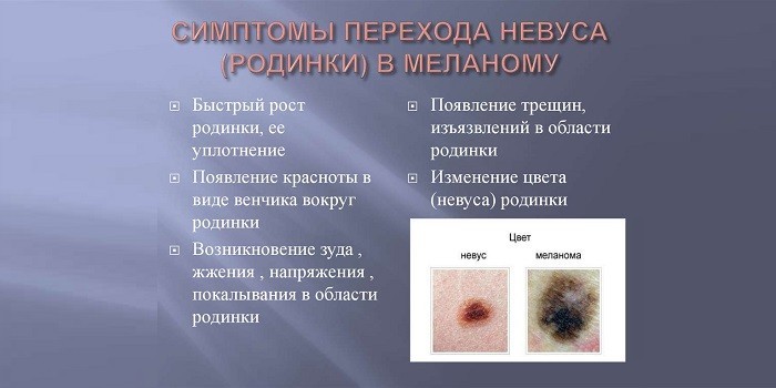 Признаки малигнизации родинок