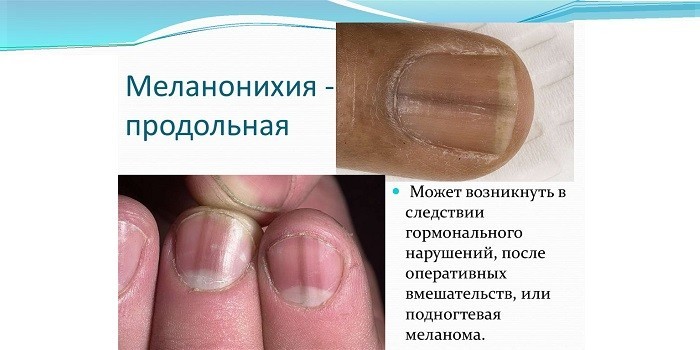 Подногтевая форма