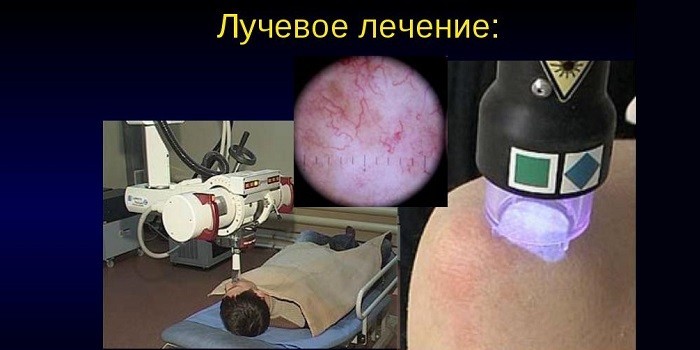 Лучевая терапия