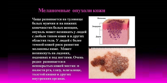 Меланомные опухоли кожи