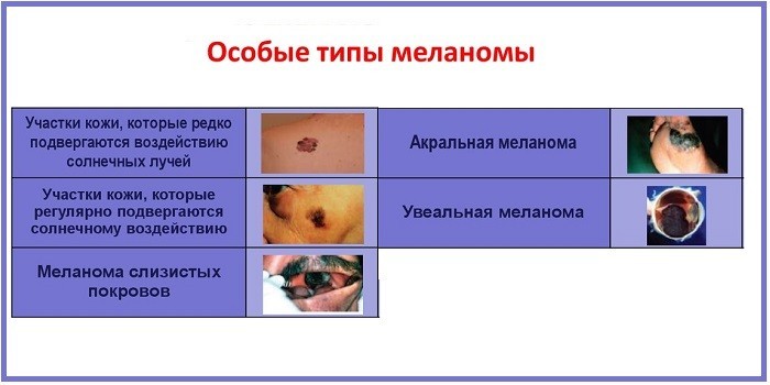 Особые типы меланомы