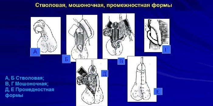 Формы аномалии 