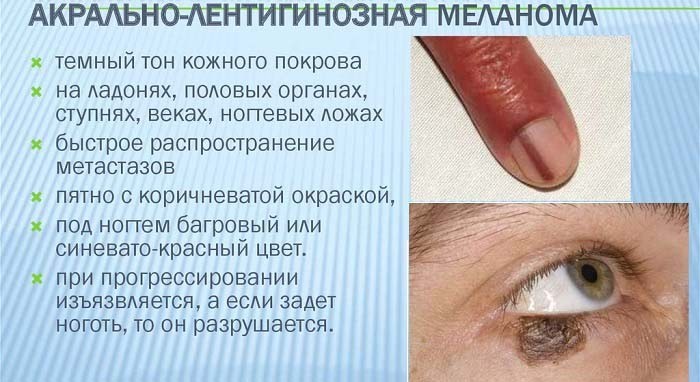 Симптоматика лентигинозной меланомы 