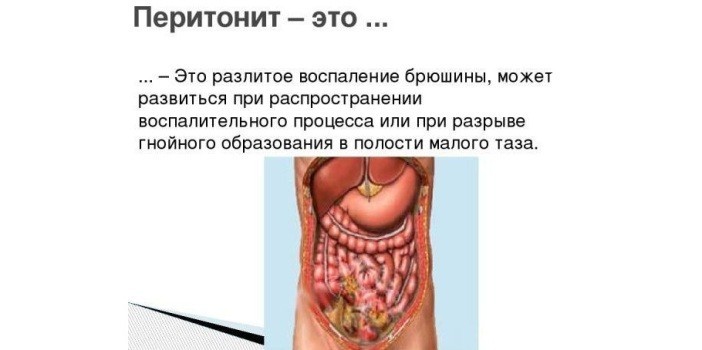 Что такое перитонит