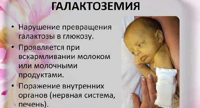 Проявления галактоземии